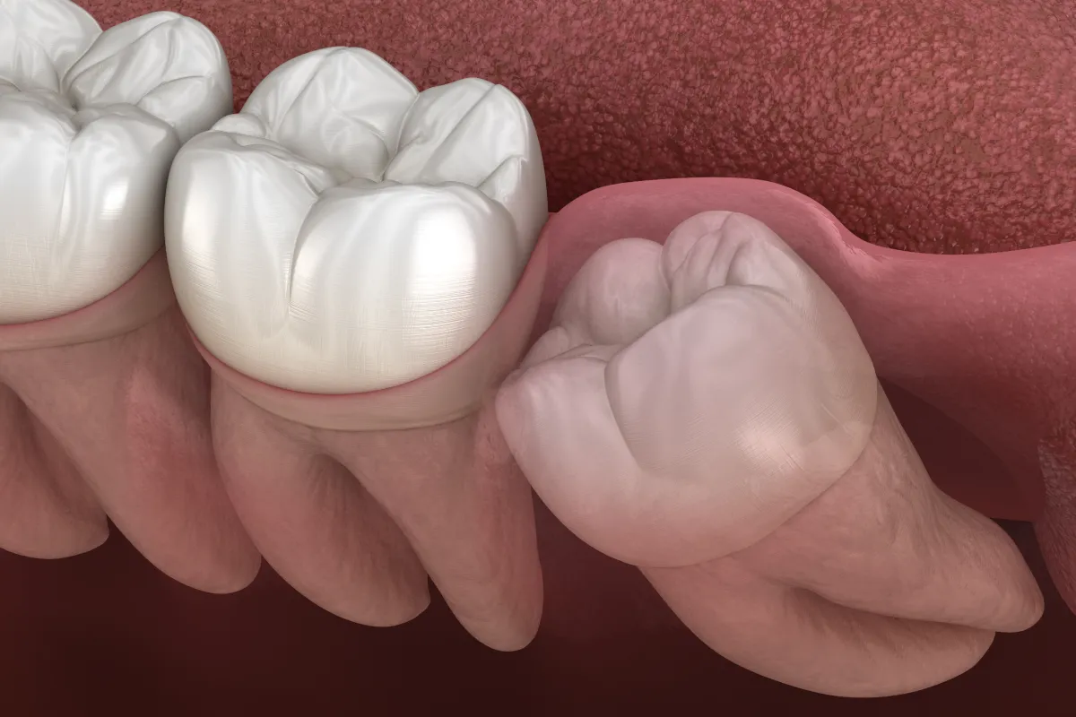 親知らずが隣り合う歯を押しているイメージ画像