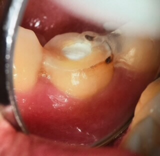 術後、2週間の写真