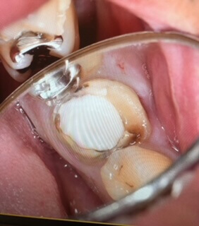 根が破折した歯の写真