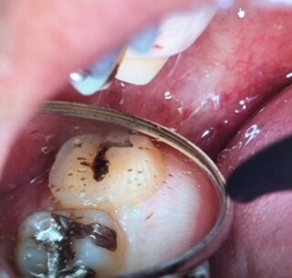 右上の親知らずの写真