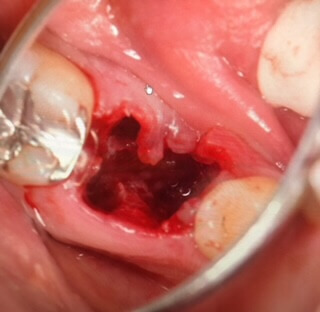 歯を抜いた直後の写真
