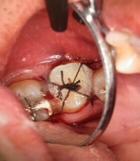 移植歯を固定した写真