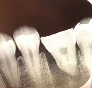 術直後のレントゲン写真