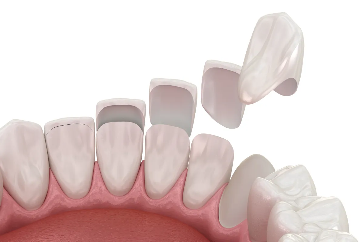 セラミック治療