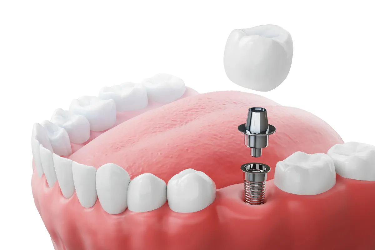 インプラント(人工歯根)