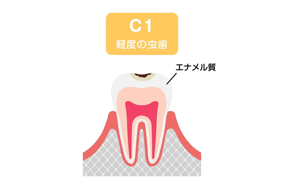 エナメル質の虫歯(C1)