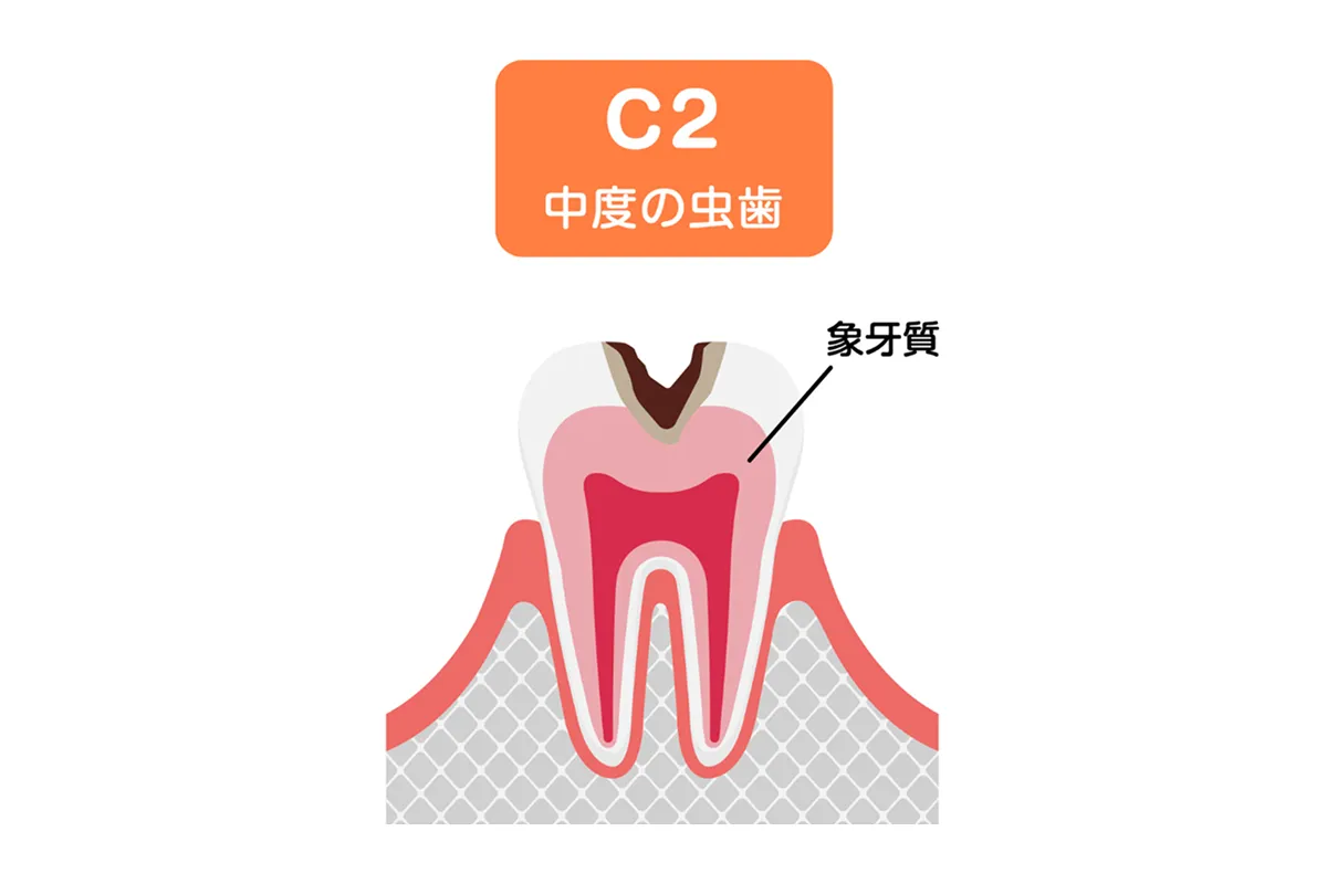 象牙質に達した虫歯(C2)