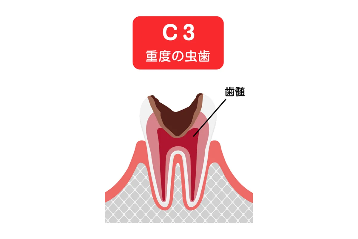 神経に達した虫歯(C3)