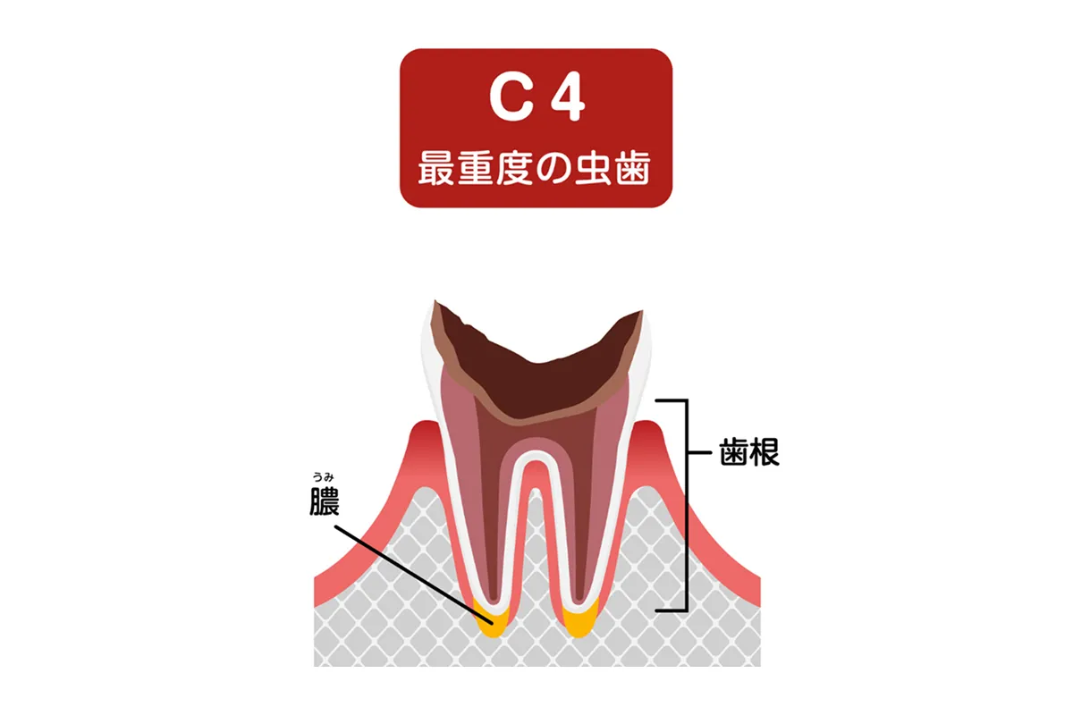 歯の根だけが残った虫歯(C4)
