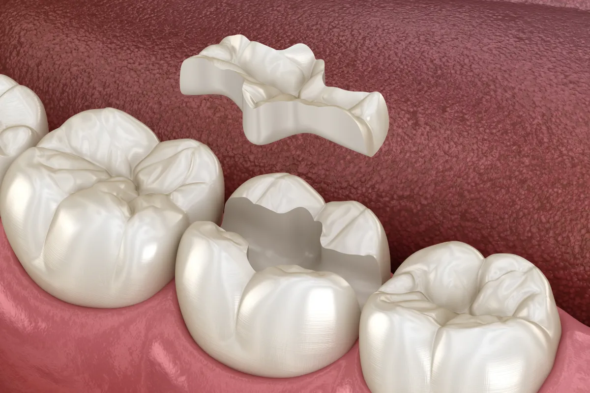 インレー(詰め物)