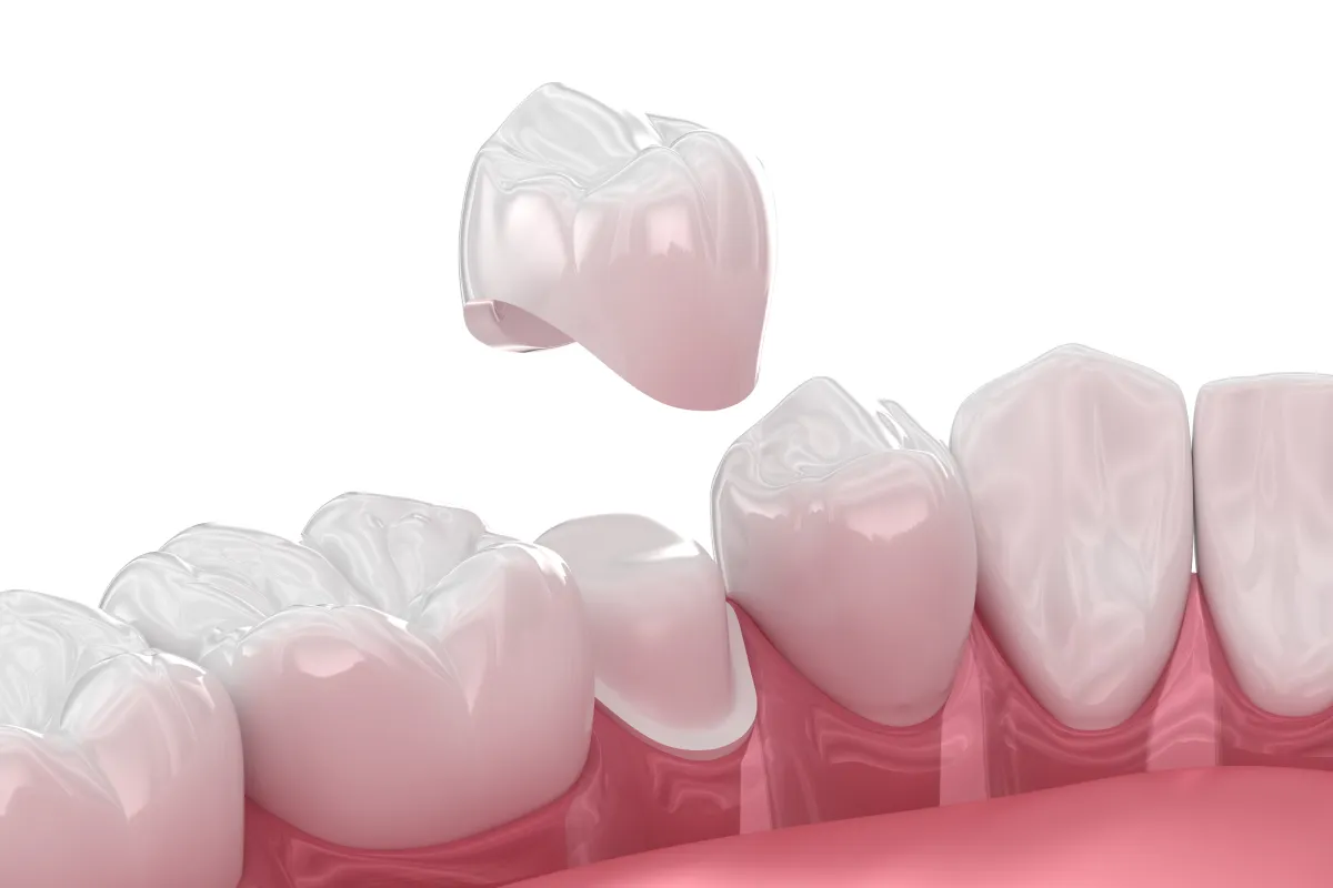 クラウン(被せ物)