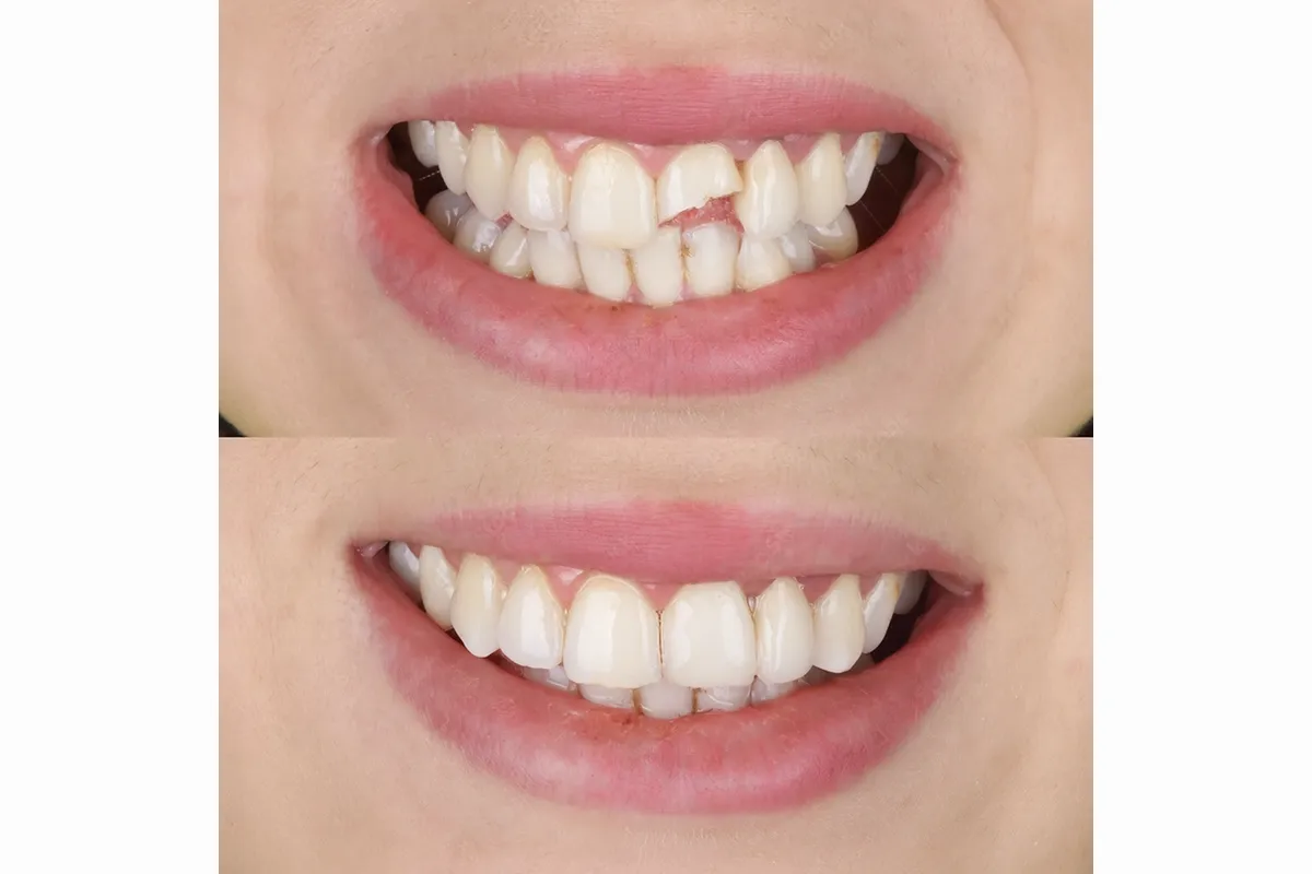 前歯の欠けの修復イメージ