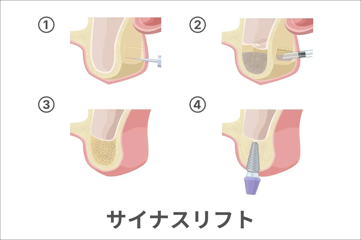 サイナスリフトのイメージ画像