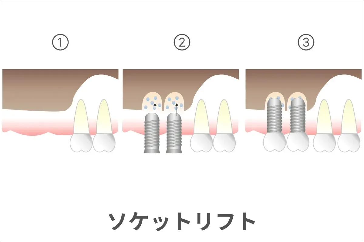 ソケットリフトのイメージ