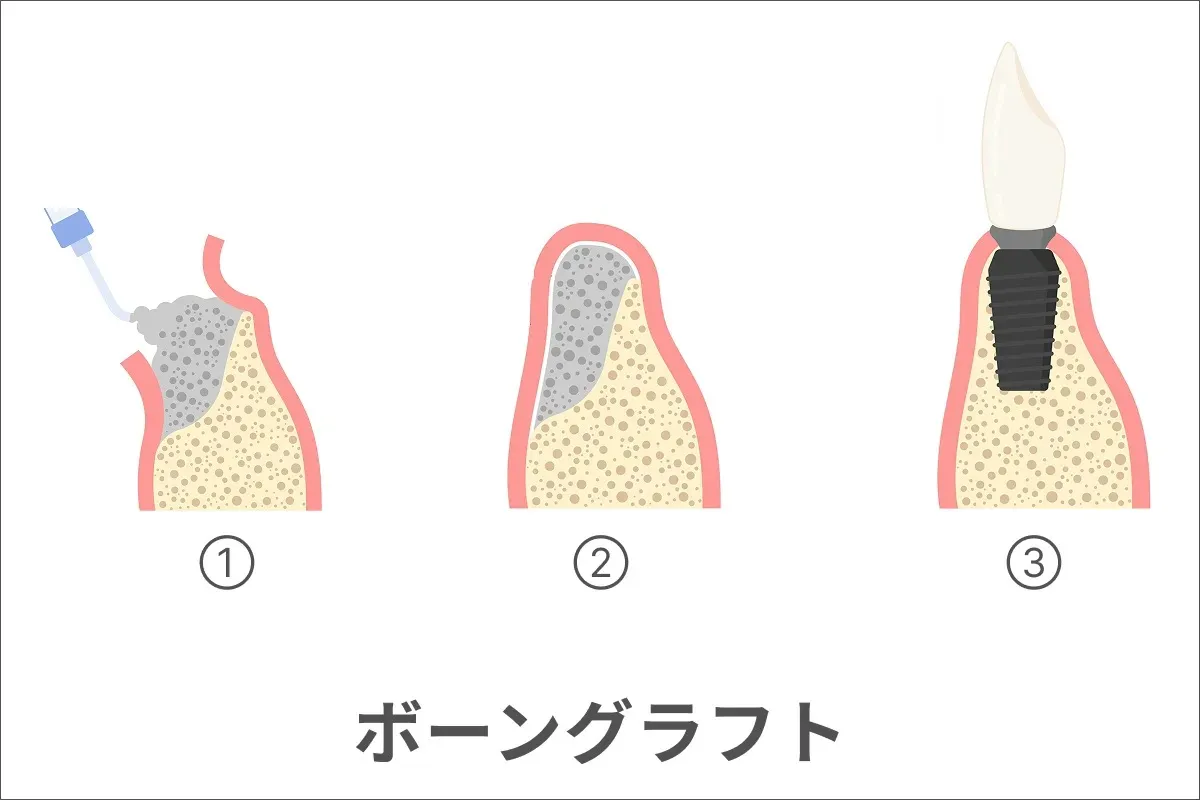 ボーングラフト