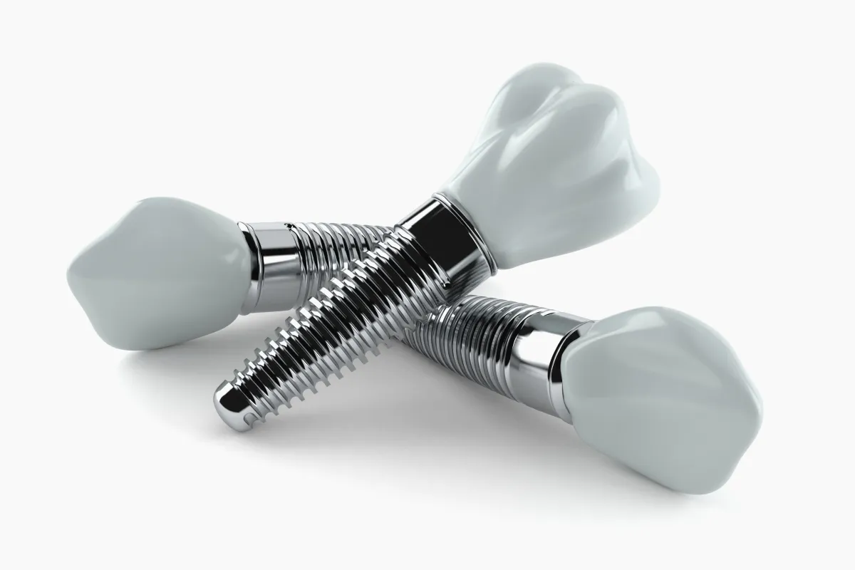 インプラントの費用の相場と歯科医院選びの３つのポイント 画像