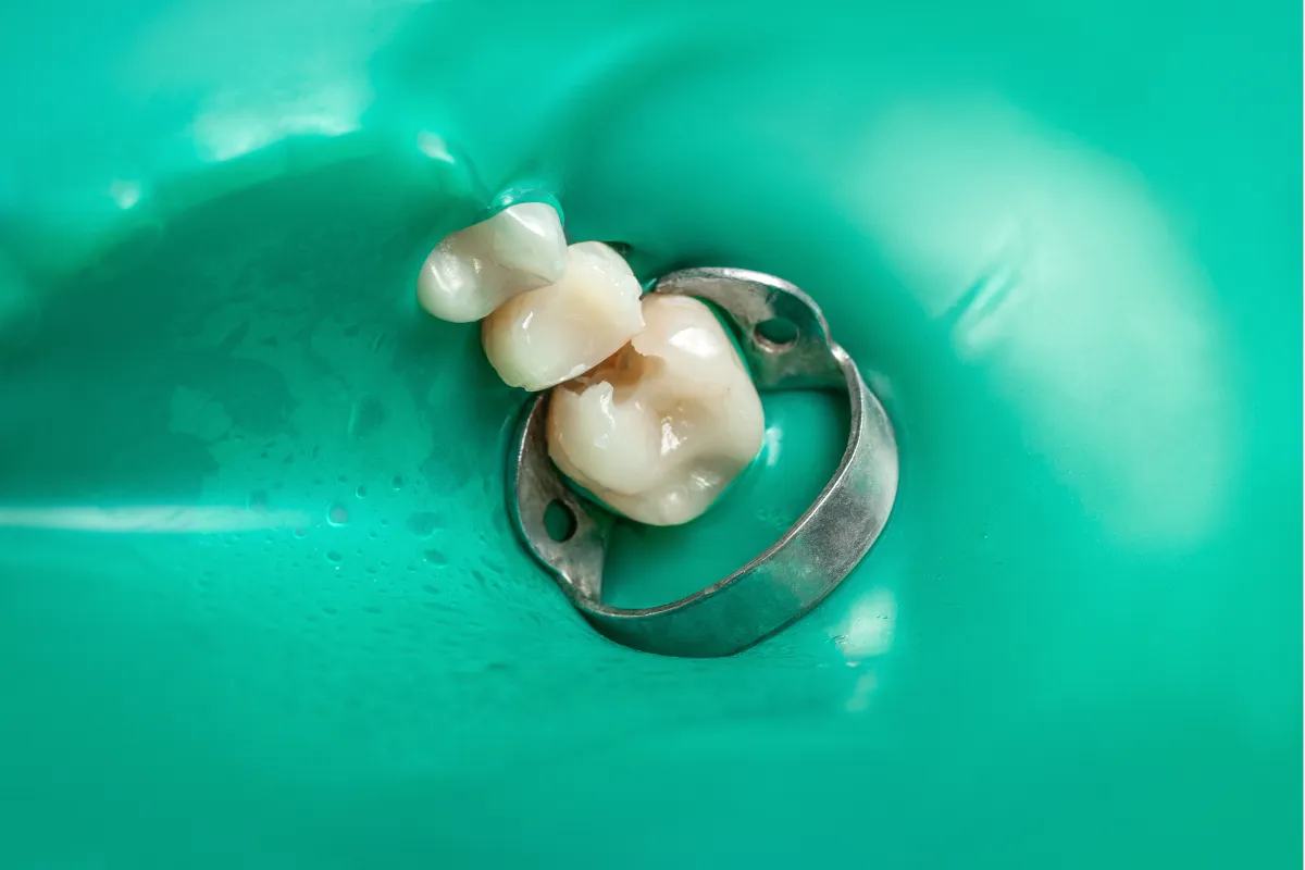 ラバーダム防湿