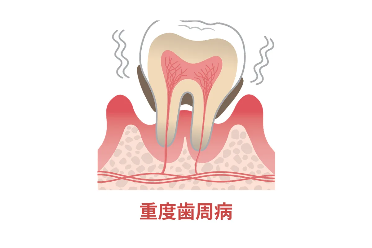 重度歯周病