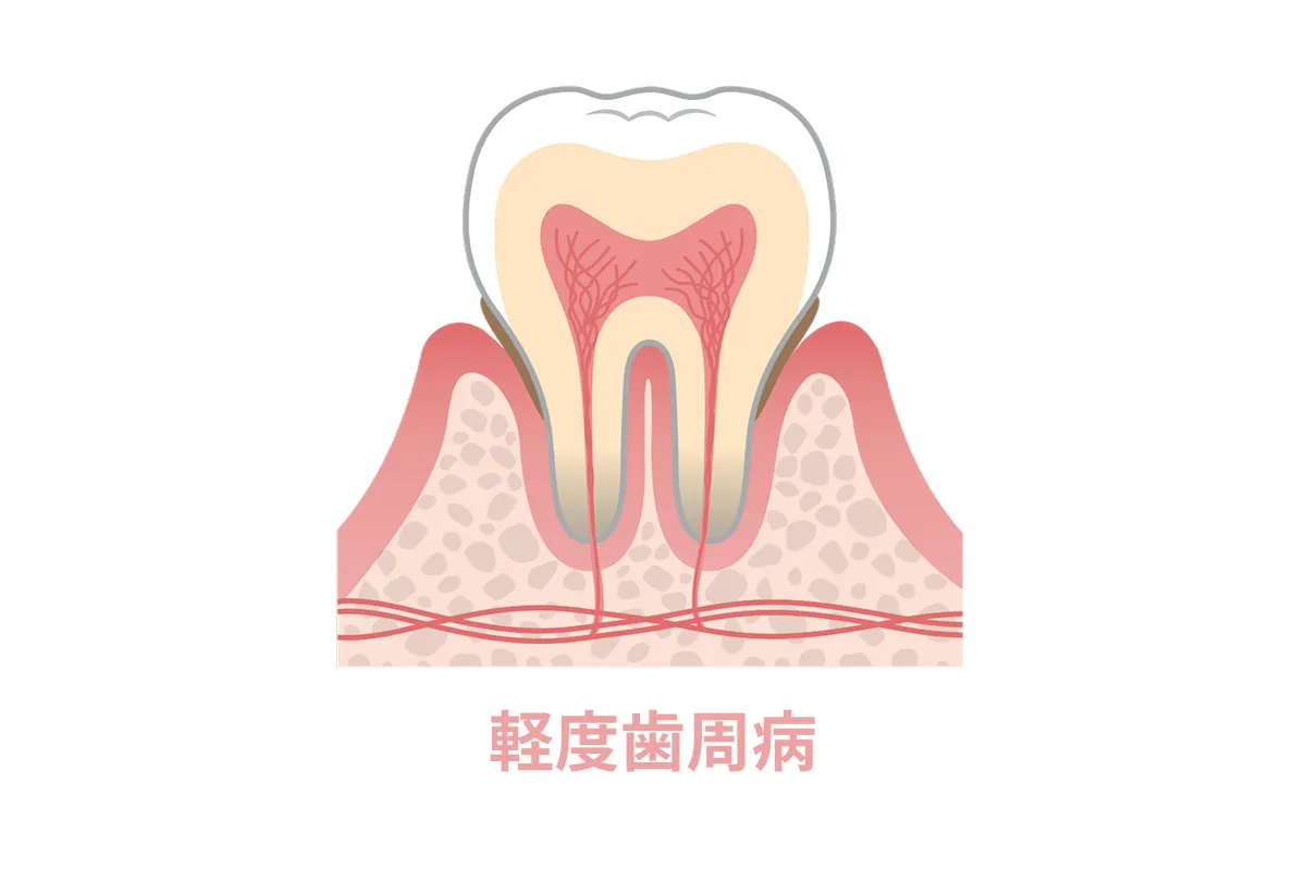 軽度歯周病(歯肉炎・初期歯周炎)
