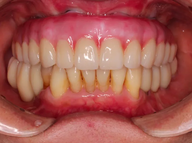 インプラントAFTER画像