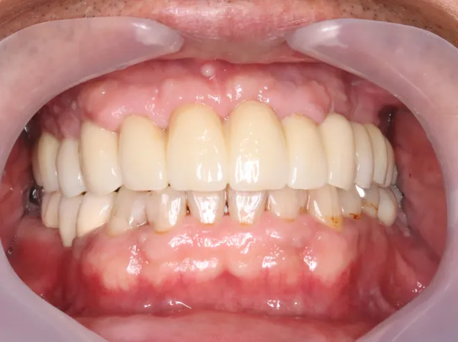 インプラントAFTER画像