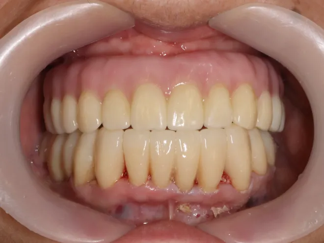 インプラント/セラミック治療AFTER画像