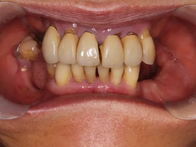 インプラントBEFORE画像