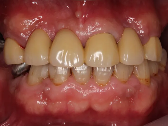 インプラントBEFORE画像