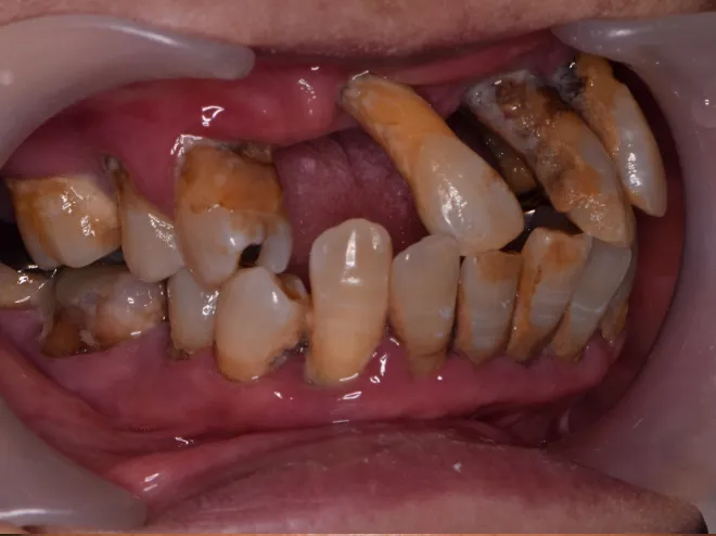 インプラント/セラミック治療BEFORE画像