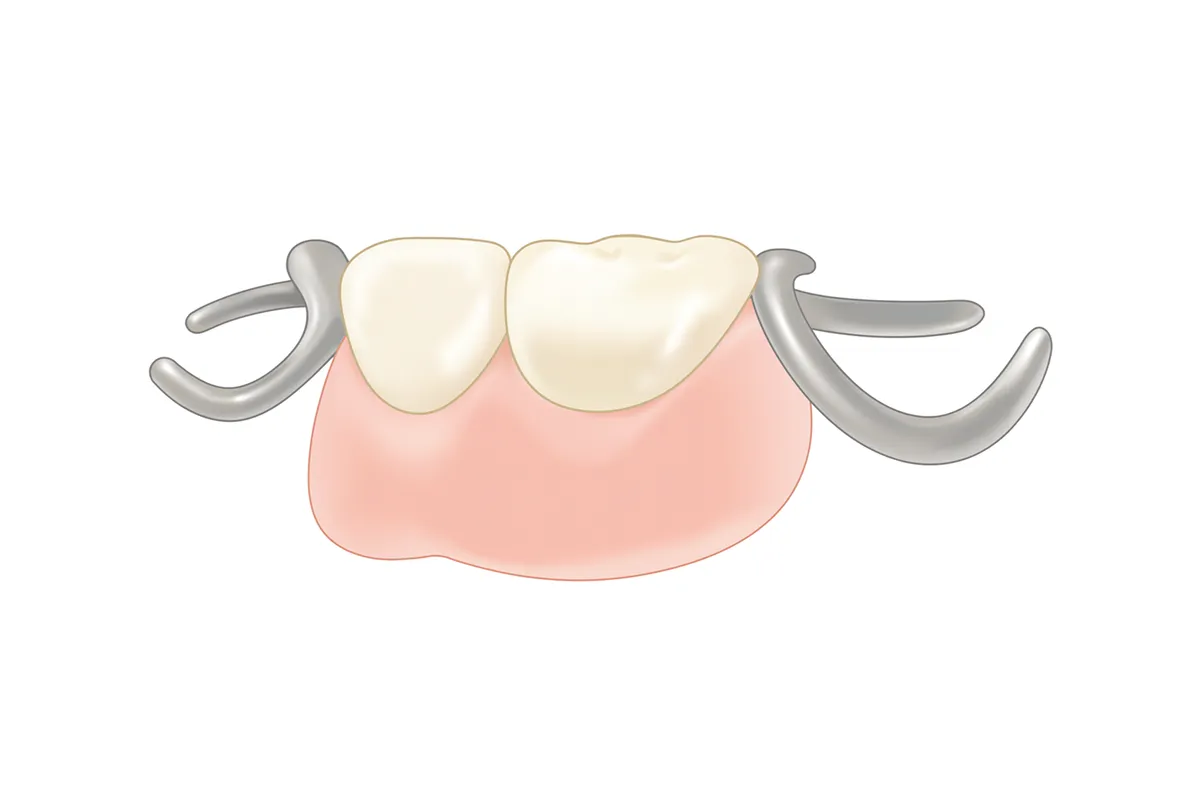 部分入れ歯