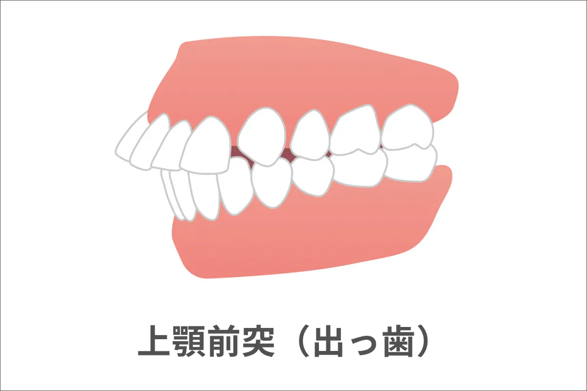 上顎前突(じょうがくぜんとつ)・出っ歯