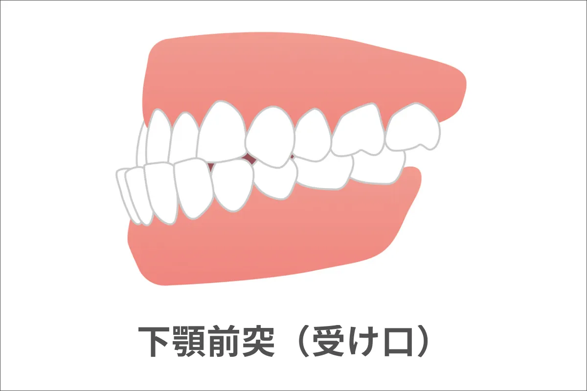 下顎前突(かがくぜんとつ)・受け口