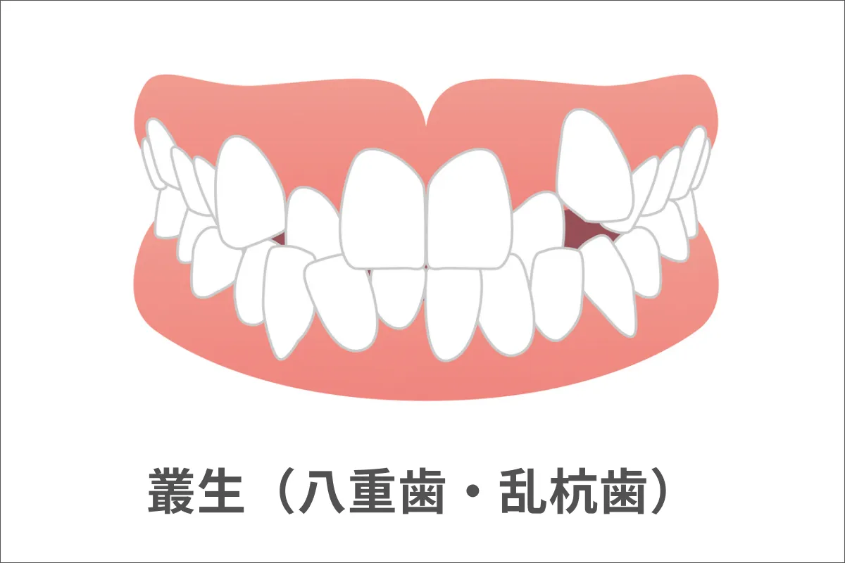 叢生(そうせい)・乱ぐい歯