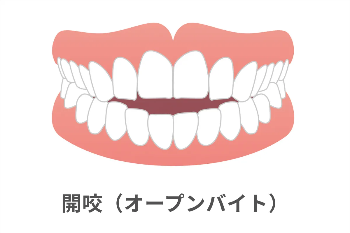 開咬(かいこう)・オープンバイト