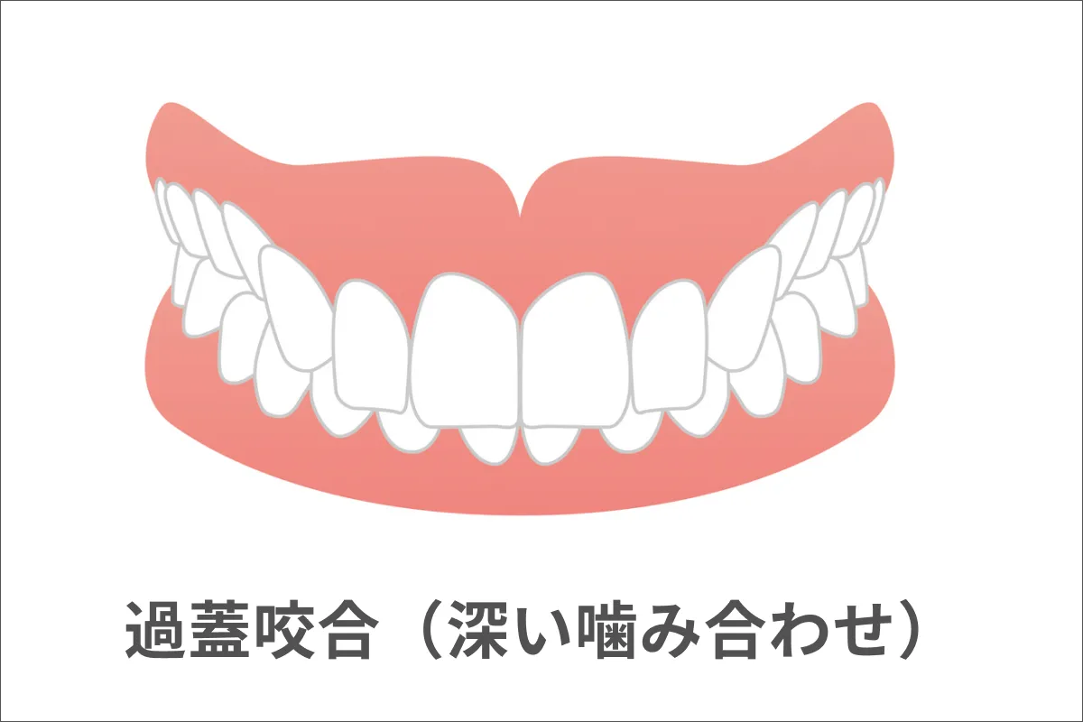過蓋咬合(かがいこうごう)