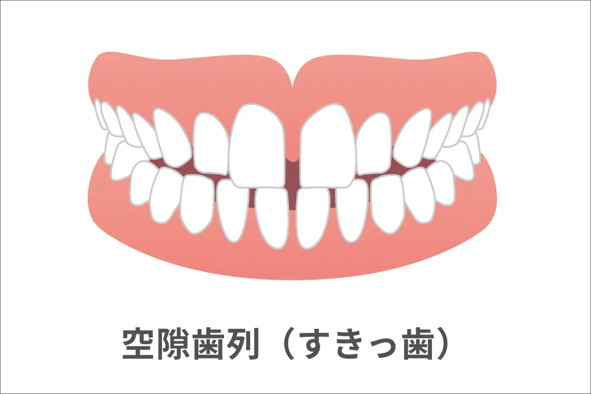 空隙歯列(くうげきしれつ)/すきっ歯
