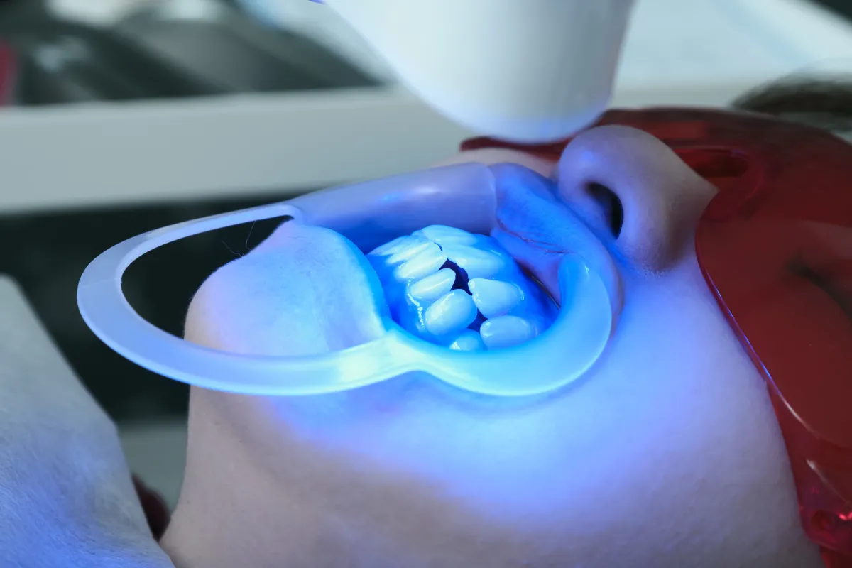 オフィスホワイトニング