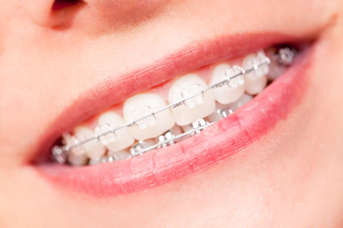 表側矯正(セラミックブラケット)