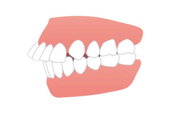 出っ歯（上顎前突）の原因って？ 画像